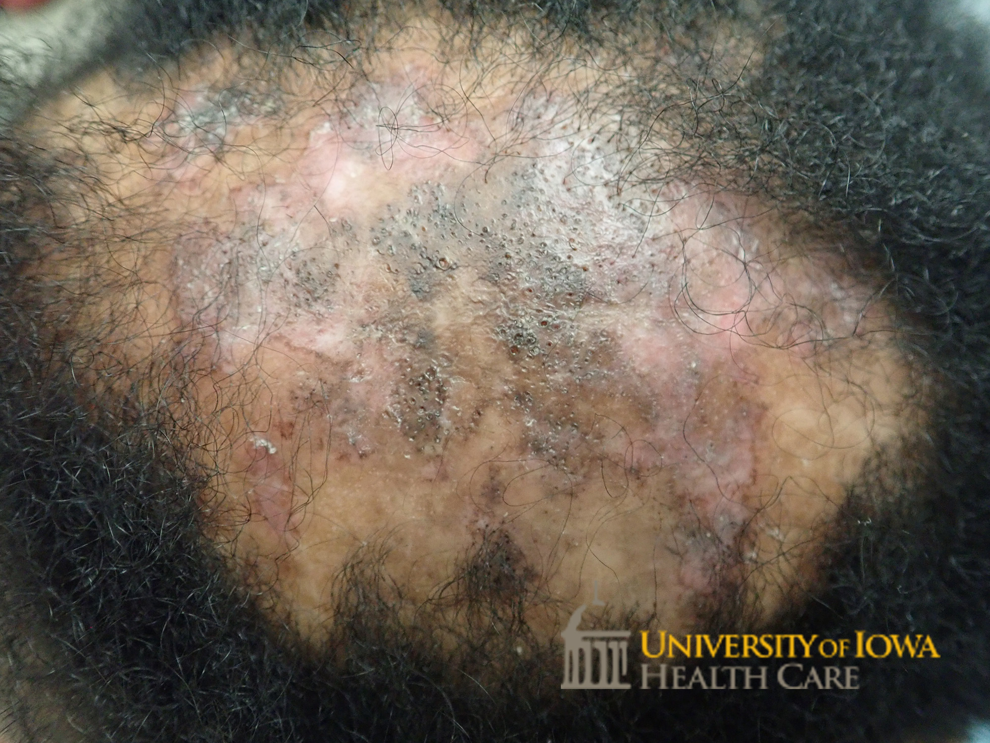 Atrophic, pink to violaceous plaque with focal areas of scale and associated scarring alopecia on the crown scalp. (click images for higher resolution).
